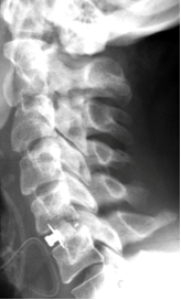 Bild einer operativen Therapie des cervikalen Vorfalls: Versteifung 5./6.Halswirbel nach Ausräumung eines Bandscheibenvorfalls                  